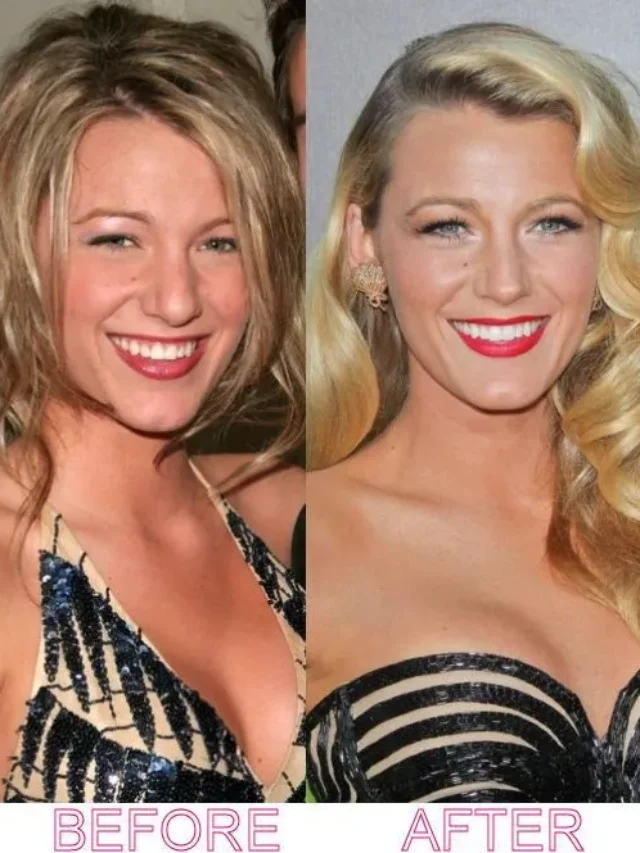 Blake Lively: The Truth Behind the Rhinoplasty Plastic Surgery Rumors